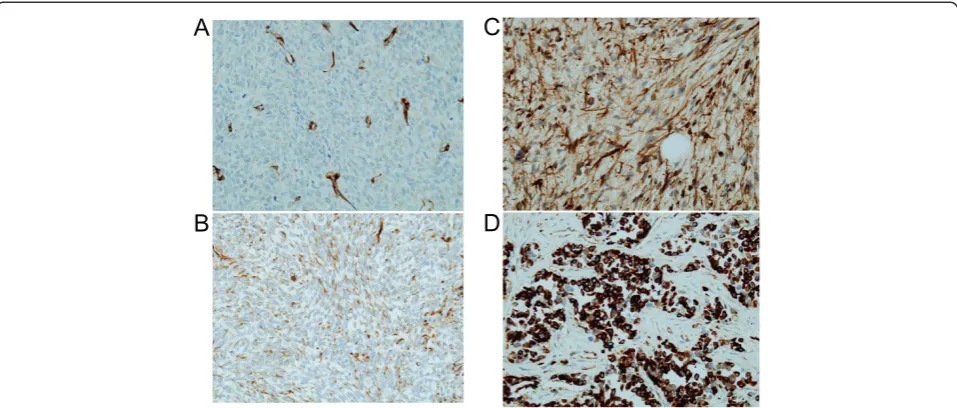 Figure 1 Immunohistochemical staining of WT1 (×400). (A) Negative staining. Note that this section shows positive staining for blood vessels.(B) Weak staining