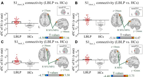Figure 1 Static functional connectivity spatial distributions were observed at the group level for LBLP patients and healthy controls (the left somatotopic S1 subregions).Abbreviations: sFC, static functional connectivity; S1, primary somatosensory cortex; LBLP, low-back-related leg pain; HCs, healthy controls.