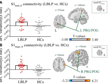 Figure 3 Differences in the alterations of dFC between LBLP patients and healthy controls (two-samplePOG in LBLP patients.Abbreviations: t-test, two-tailed, voxel-level P < 0.01, GRF correction, cluster-levelP < 0.05).Notes: (A) Increased dFC between the r