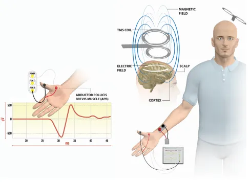 Figure 1 Stimulation and recording techniques for SAI measurements. Notes: The TMS coil is positioned tangentially to the central sulcus over the left M1