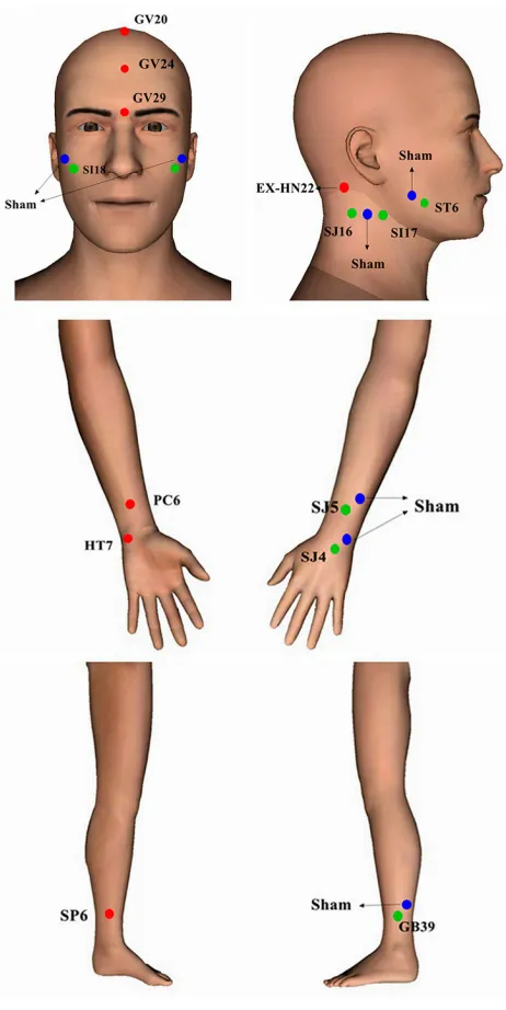 Figure 1 Real and sham acupoints.