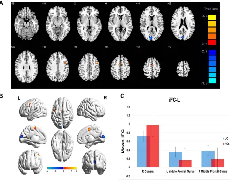 Figure 1 Differences in FC of the left V1 between patients with CU and HCs.Notes: (A and B) Notable differences in FC of the left V1 were observed