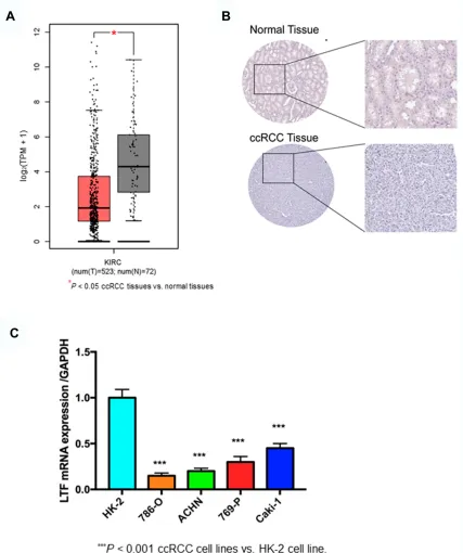 Figure 5 Validation of hub gene. (A) Differential expression of LTF gene in ccRCC tissues and normal tissues based on GEPIA (http://gepia.cancer-pku.cn/)