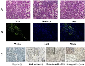 Table 2 Correlation of Wnt5a Expression with Clinicopathological Variables