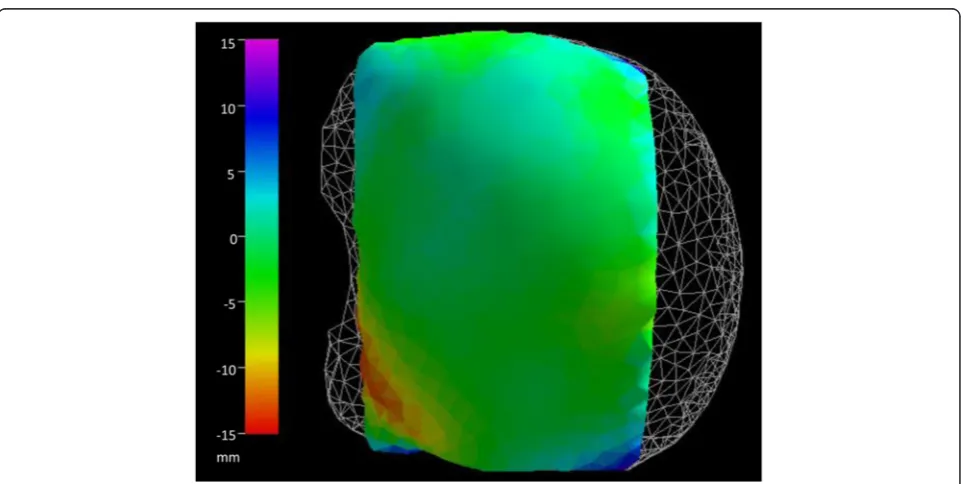 Fig. 1 The white mesh represents the un-deformed liver surface. The color code represents the distance between the simulated and the realdeformed surface from two vertical compression paddles