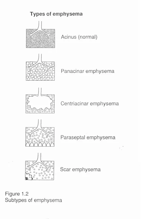 Figure 1.2Subtypes of emphysema