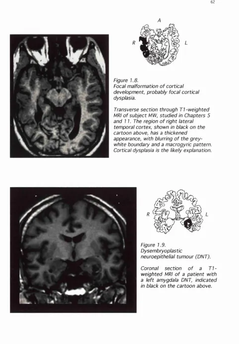Figure 1.8.Focal malformation of cortical 