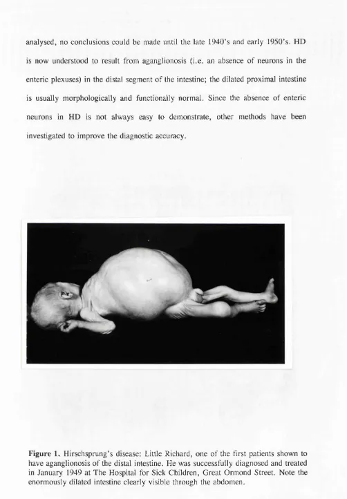Figure 1. Hirschsprung’s disease: Little Richard, one of the first patients shown to 
