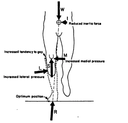 Figure 13 • The effect of a foot inset upon socket loading.