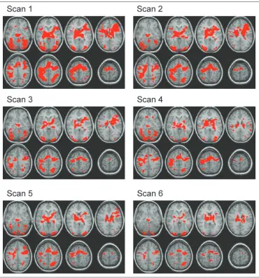 Figure 4. Axial view (A) atz coordinate 41 of frontaland parietal areas thatdecreased with practice (seeTable 1 for peak activationcoordinates)