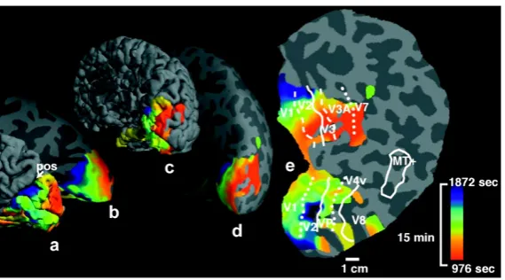 Fig. 2 Source localization of the magnetic resonance (MR) data signal of SD (from [entire hemisphere from posterior-medial view (oblique forward facing), folded and inﬂated, respectively.As described in the original study [green and bluethe migraine attack