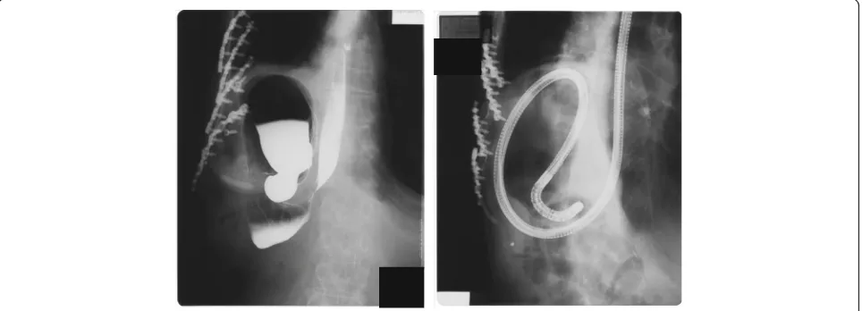 Fig. 1 Chest X-ray and chest CT of case 1 Chest X-ray (left) and chest CT (right) show a left diaphragm hernia