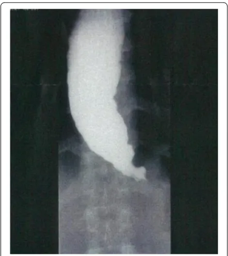 Fig. 3 The esophageal radiography of case 2. The esophagealradiography shows dilation of the esophagus and a “bird-beak”appearance, which are characteristics of esophageal achalasia