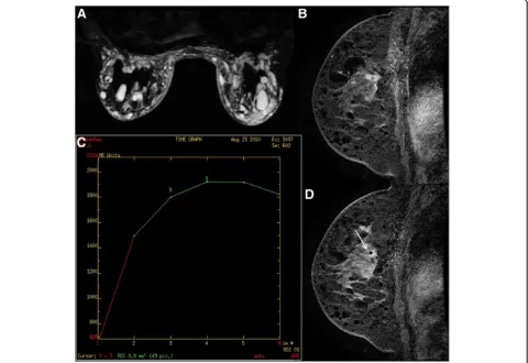 Figure 2 Example of ductal carcinoma in situ after silicone injection in the breast. A 44-year-old woman who received silicone injectionhad a suspicious lesion in the left breast on magnetic resonance imaging (MRI) screening