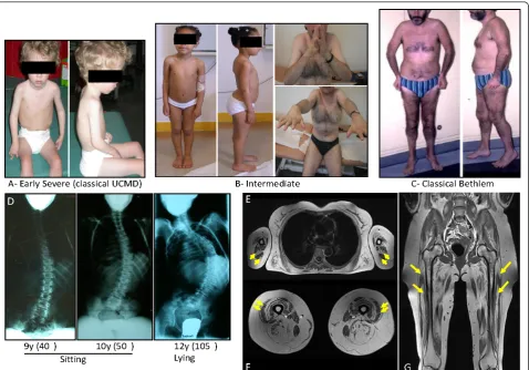Figure 2 Clinical spectrum, associated spine deformation and muscle MRI in collagen type VI (ColVI) myopathiesaround the triceps brachialis muscles in (E) and along the fascia of vastus lateralis and vastus medialis muscles in (F) (yellow arrows).concentri