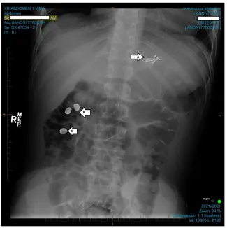 FIGURE 1Multiple foreign bodies. A, Blunt, small, metal screws in the stomach. B, Multiple button batteries inthe descending colon