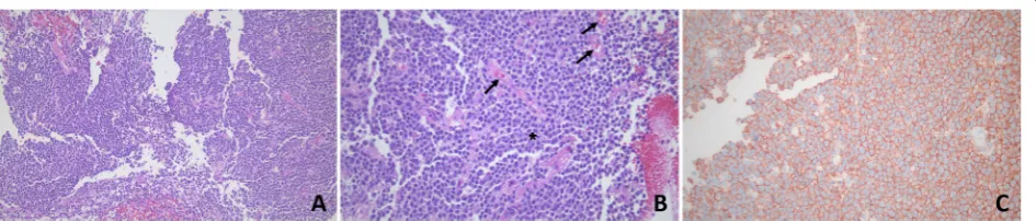 Fig. 2 The outcome of brain biopsy. a Hematoxylin and eosin (H&E) stained slide (× 200) shows a diffuse large B-cell lymphoma