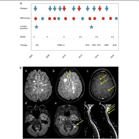Fig. 1 (A) Patient’s history was characterized by sustained disease activity. Red arrows correspond to relapses, which caused disabilityaccumulation