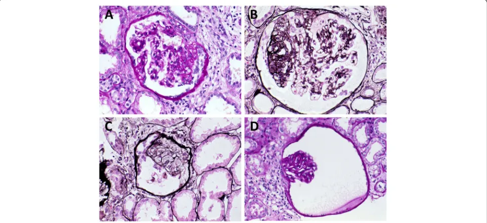 Fig. 1 Microscopic findings of the first renal biopsy at the age of 19. Glomeruli have multiple segmental sclerotic lesions (panels a, b, and c:periodic acid-Schiff stain; panel d: periodic acid-methenamine-silver stain)