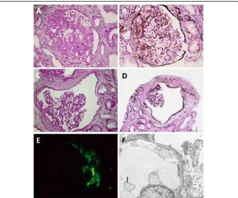 Fig. 3 Microscopic findings of the second renal biopsy at the age of 23. Glomerular sclerosis had progressed compared to 4 years agoto the Bowman(panels a and c: periodic acid-Schiff stain; panels b and d: periodic acid-methenamine-silver stain)