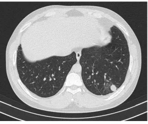 Figure 1: Interstitial pneumonia with eosinophilic granulomas presenting as a solid left lower 