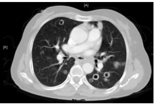 Figure 4: "CT angiogram sign" 