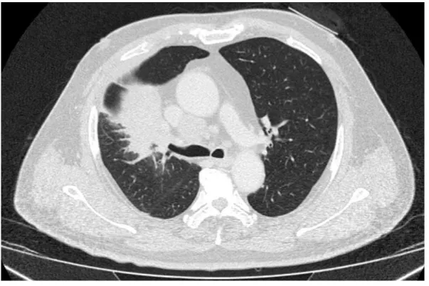 Figure 6: Small cell carcinoma of the right upper lobe with ipsilateral mediastinal lymphadenopathy (33) 