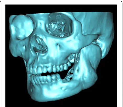 Figure 2 The virtual osteotomy of the affected mandible wasperformed on the software.
