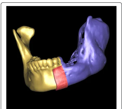Figure 6 The virtual harvesting graft on the iliac crest.
