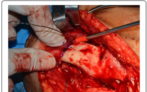Figure 9 A shaping template was designed so that it exactlycovered the surface of the virtually reconstructed mandibleand was used to maintain the mandibular position during theoperation and guide the graft into the proper position.