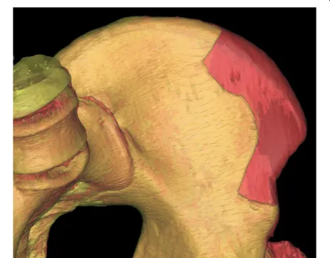 Figure 12 Using a shaping template, the iliac graft was shapedand placed into the proper position.