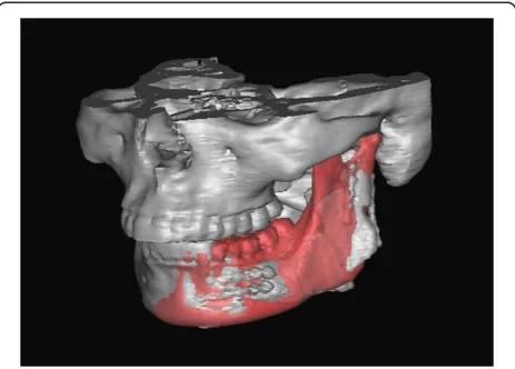 Figure 18 Overlapping pre- and postoperative mandibles. Errorwas measured between the virtual osteotomy line (green arrow) andthe actual osteotomy line (black arrow).