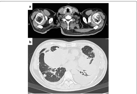 Figure 4 Macroscopic and histological findings of the excised specimen. (a) Gross appearance of the resected tissue showing a solid, white-yellowish tumor with bleeding and necrosis