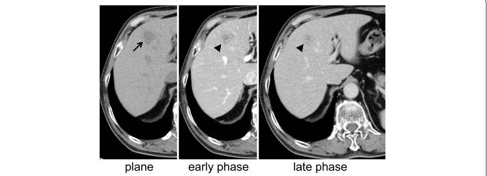 Figure 1 Computed tomography (CT) findings nine years after the first surgery. A 14-mm low-density area (arrow) in segment 8 of the liver(plane) is observed
