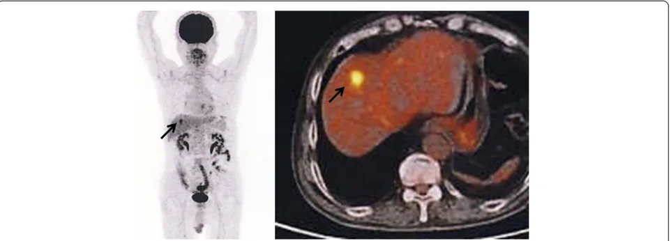 Figure 2 Dynamic contrast-enhanced magnetic resonance imaging (MRI) findings with gadolinium ethoxybenzyl diethylenetriaminepentaacetic acid (EOB-MRI)