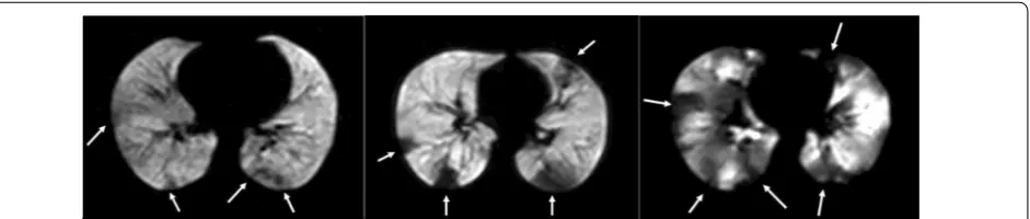 Fig. 4 Hyperpolarized helium-3 MRI axial slice of a mild asthmatic (left panel), a moderate asthmatic (middle panel), and a severe asthmatic (right panel)