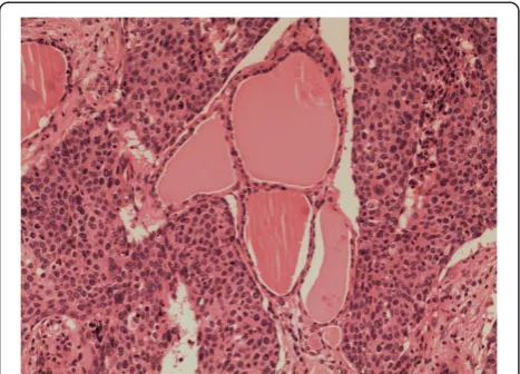 Figure 2 Multi-focal nests of tumors cells are distributednearby the follicles. Hematoxylin and eosin staining, ×100.