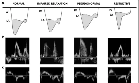 Fig. 1 Progression from normal diastolic function to worsening degrees of left ventricular diastolic dysfunction (LVDD)