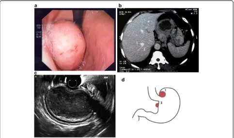 Figure 1 Imaging and schematic representation of double GIST in case report 1. a. Case report 1