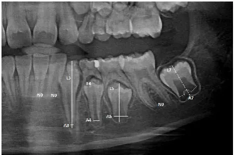 Fig. 1. An example of tooth measurement: N0, teeth with apical ends completely closed; Ai, i=1,...,5 (teeth with one root), is the distance between the inner sides of the open apex; Ai, i=6, 7 (teeth with two roots), is the sum of the distances between the inner sides of the two open apices; and Li, i=1,...,7, is the length of the seven teeth  