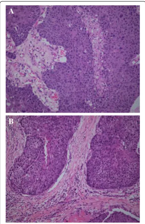 Figure 3 Histopathological specimen images.similar to that of the primary lesion of the tracheaspecimen Nasopharynx (A) showing squamous cell carcinoma with morphology (B).