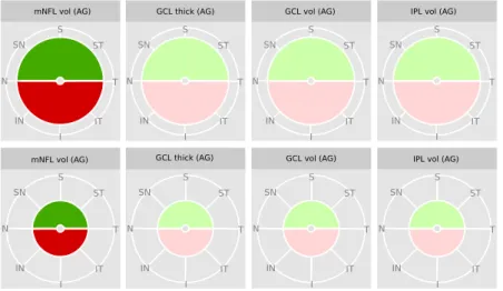 Figure 3.4: Differences in moderate glaucoma maculae ganglion cell layer (GCL), inner plexiform layer (IPL) and  macular  nerve  fibre  layer  (mNFL)  thickness  (thick)  and  volume  (vol)  at  corresponding  hemizones  and   inner-hemizones