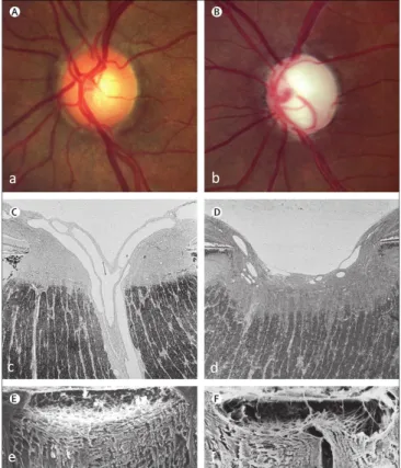 Figure  1.3:  Features  of  healthy  (left)  and  glaucomatous  (right)  optic  nerve  heads  (ONH)