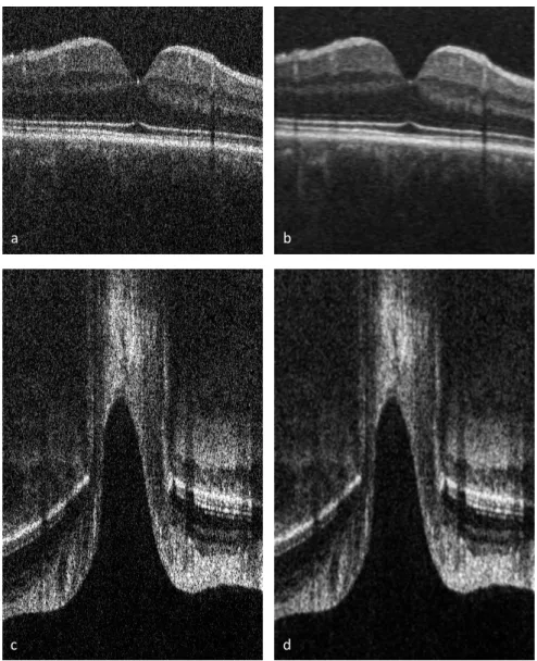 Figure  2.4:  Macula  (above)  and  optic  nerve  head  (ONH,  below)  images  before  (a  and  c)  and  after  (b  and  d)  filtering to improve visibility of retinal and ONH structures