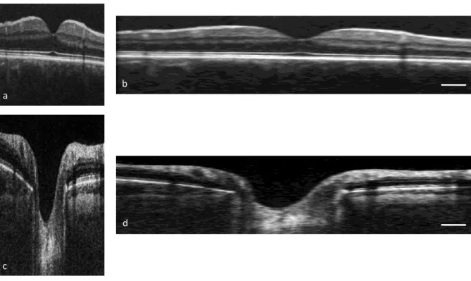 Figure 2.6: Processed OCT images of the macula (above) and optic nerve head (ONH, below) prior to (a and c)  and  after  (b  and  d)  scaling  using  the  modified  Littmann  equation