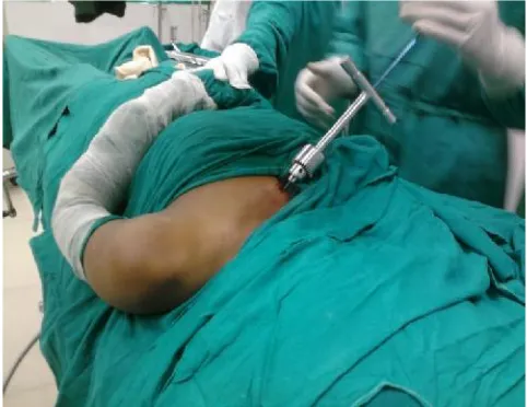 Fig. 1. Method of inserting nail from medial side of clavicle