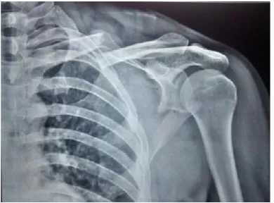 Fig. 2. Pre-op xray 30 yr male with fracture clavicle and scapulaleft side