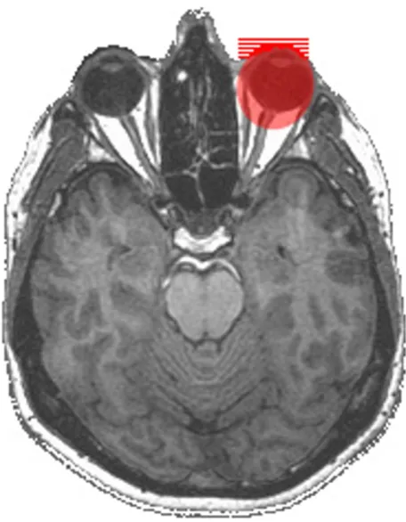 Figure 2Orbital anatomyOrbital anatomy. High-resolution axial T1-weighted native MRI of a volunteer without structural abnormalities at 3.0 Tesla