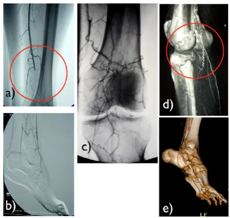 Fig. 7.  Angio-TC scans of coronary arteries in a 56-years old male patient suffering for angina pectoris, taken before and 2 years after oral pRelaxin treatment