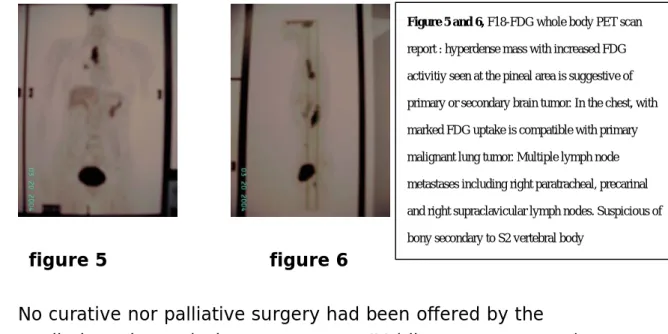 Figure 5 and 6, F18-FDG whole body PET scan  report : hyperdense mass with increased FDG  activitiy seen at the pineal area is suggestive of  primary or secondary brain tumor
